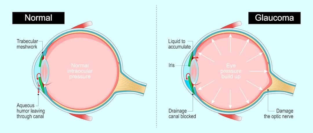 Illustration of normal eye pressure compared to eye with glaucoma increased IOP.