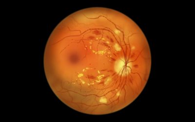 Illustration of eye showing signs of macular edema and diabetic retinopathy conditions.