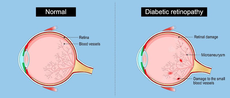 Graphic illustrating differences between normal eye condition and eye with diabetic retinopathy conditions.
