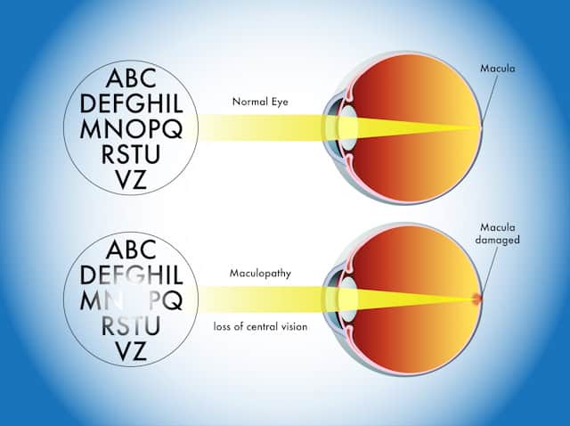 Illustration showing normal eye vision and central vision loss example of maculopathy.