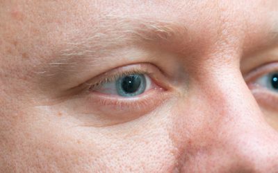 Close-up of dilated pupils for man at comprehensive eye exam at Chang Eye Group in Pittsburgh.
