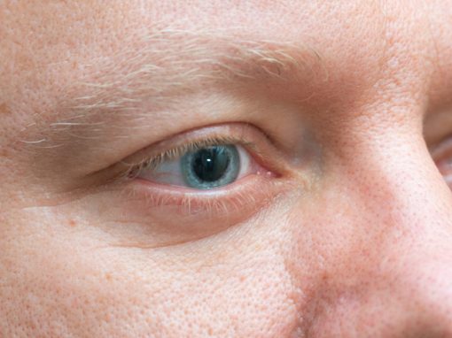 Close-up of dilated pupils for man at comprehensive eye exam at Chang Eye Group in Pittsburgh.